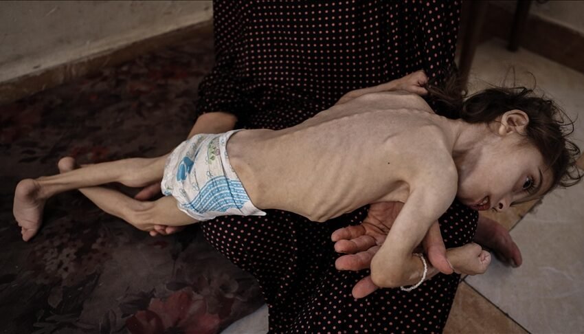  Uria që Izraeli imponon në Gaza kërcënon jetën e vajzës 6-vjeçare