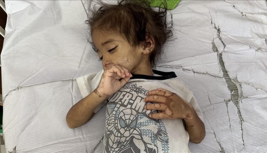  Vogëlushi nga Gaza në luftë për mbijetesë për shkak të urisë së imponuar nga Izraeli
